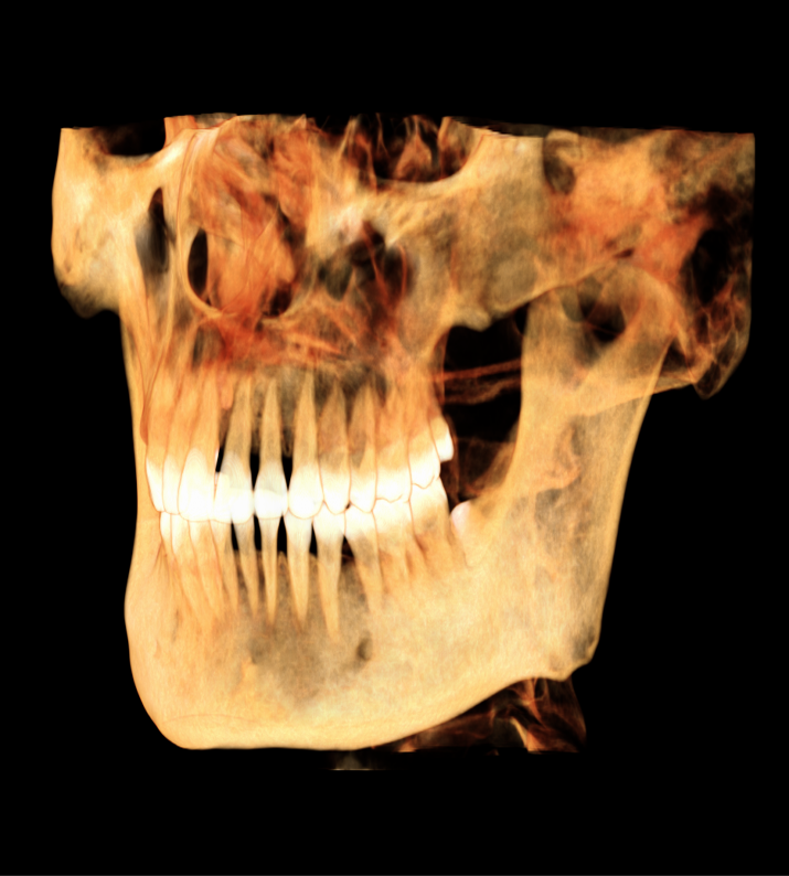 3D reconstruction before spine removal